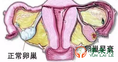 孕来乐告诉你：卵巢早衰的主要原因有哪五个？