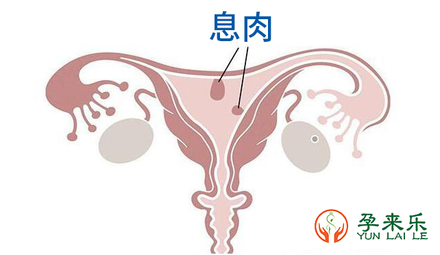 子宫内膜息肉怎么办？子宫内膜息肉要不要做宫腔镜？
