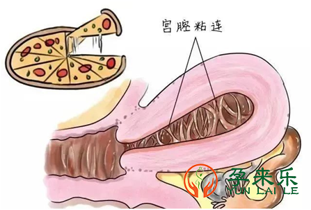 子宫内膜息肉怎么办？子宫内膜息肉要不要做宫腔镜？