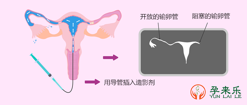 输卵管是否通畅该怎么判断？