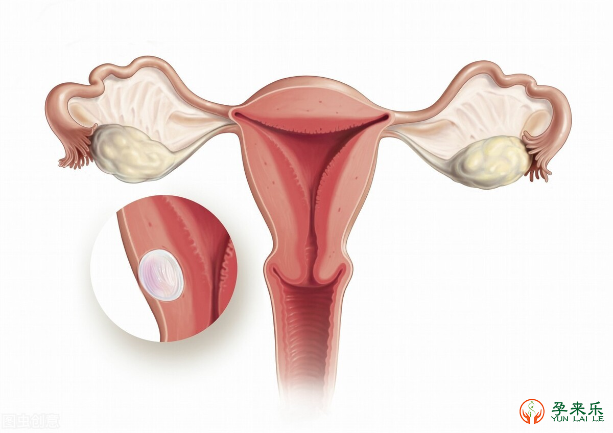 子宫内膜异位症可以治愈吗？