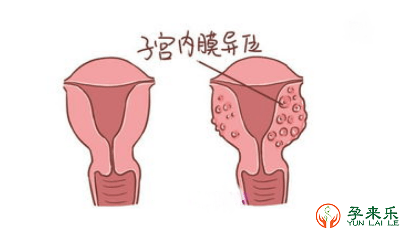 子宫内膜异位如何治疗?