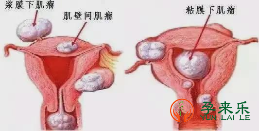 有子宫肌瘤可以正常生育吗？