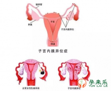 什么是子宫内膜异位症？子宫内膜异位症能试管