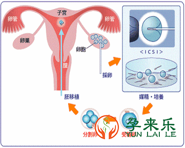 促排卵方案有哪些？看看你适合用哪种？