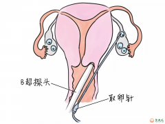 做试管婴儿会很痛吗？解读三代试管过程？