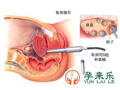 试管婴儿促排卵难受吗？一次促排能取多少颗卵子？