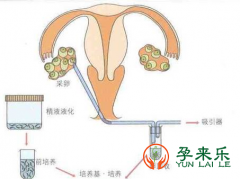 试管婴儿促排卵难受吗？一次促排能取多少颗卵