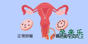 多囊卵巢做试管婴儿成功率高吗？