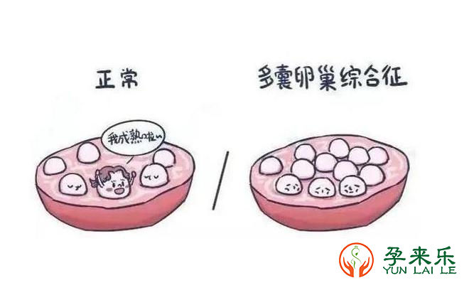 什么是多囊卵巢综合征？引起多囊卵巢的原因是什么?