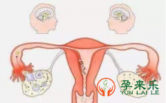 怎样预防多囊卵巢综合征?多囊卵巢有哪些危害