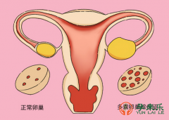 什么是多囊卵巢综合症？多囊卵巢综合症能做试