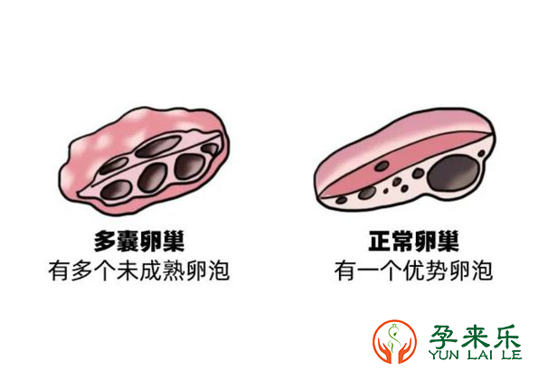 什么是多囊卵巢综合症？多囊卵巢综合症能做试管婴儿吗？