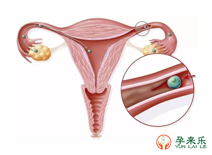 宫腔黏连为什么会导致不孕？宫腔黏连可以做试管婴儿怀孕吗？