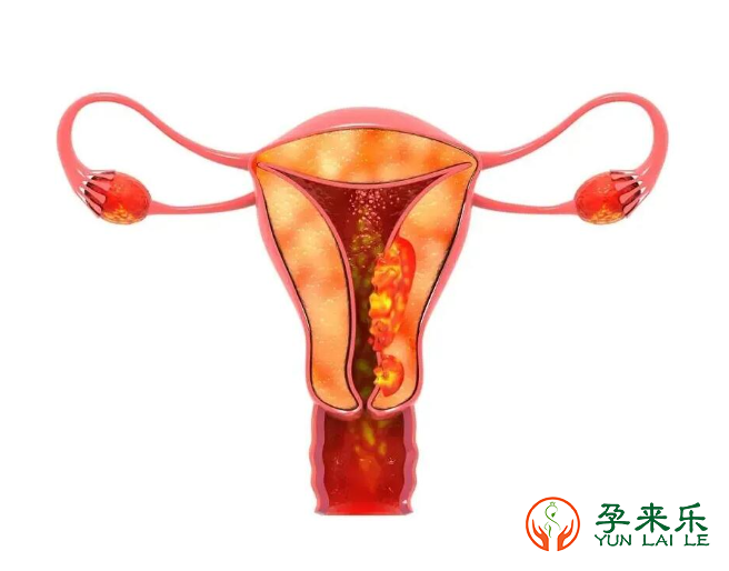 子宫腺肌症是怎么造成不孕的？子宫腺肌症能做试管婴儿吗？