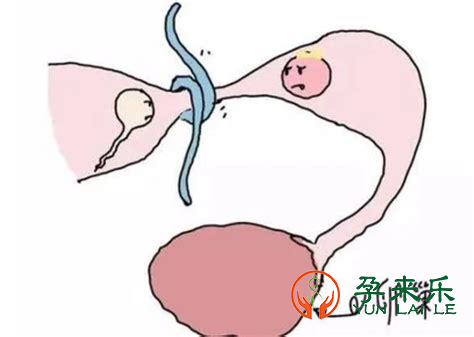 输卵管阻塞还是会排卵的吗？输卵管阻塞还能自然怀孕吗？