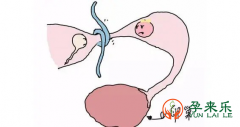 输卵管通液后多久可以同房怀孕？输卵管通液后