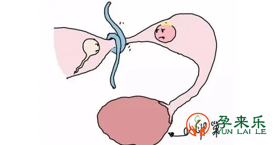 输卵管通液后多久可以同房怀孕？输卵管通液后自然怀孕难吗？