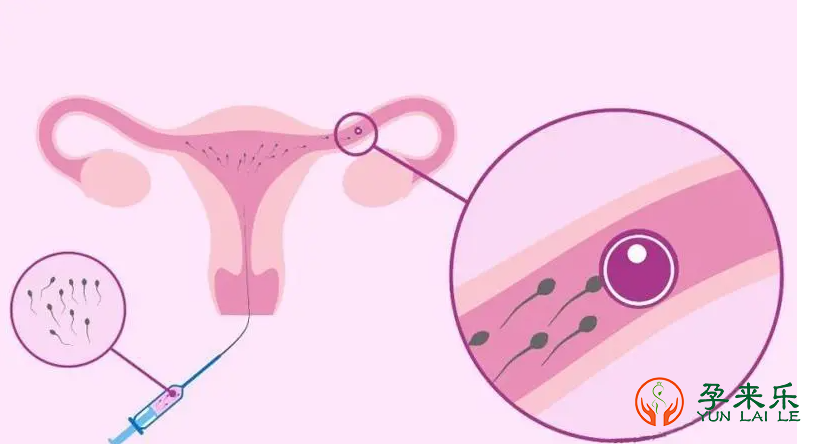什么是输卵管堵塞？输卵管堵塞可以试管吗？