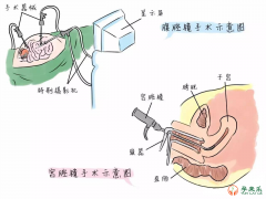 什么是宫腔镜？哪些人需要做宫腔镜检查?