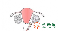 试管为什么要促排取卵？取卵后卵巢要多久才能