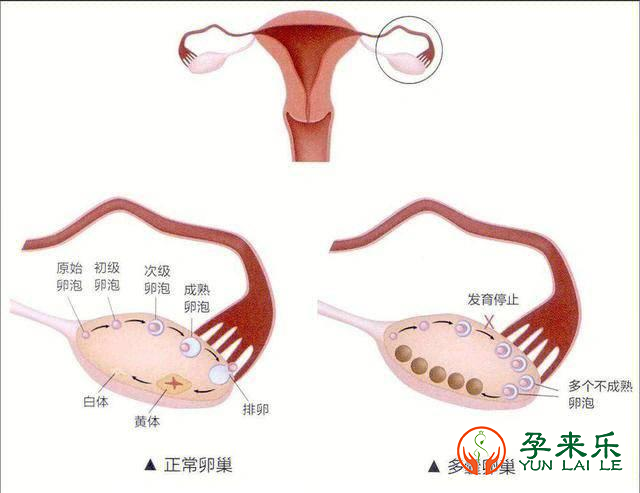 多囊的症状是什么？多囊可以做三代试管吗？