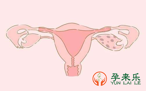 多囊卵巢的女性做试管必须注意些什么