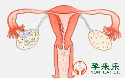 多囊卵巢是怎么导致不孕的？多囊卵巢综合症可以做试管婴儿吗？