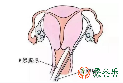 试管婴儿取卵过程中取卵到底痛不痛？选择全麻还是局麻？
