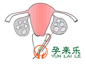 试管婴儿取卵过程中取卵到底痛不痛？选择全麻还是局麻？
