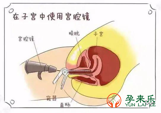  什么是宫腔镜检查？试管移植哪些情况下需要做宫腔镜检查？