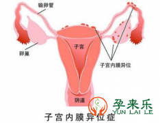 子宫内膜异位症可以治愈吗？