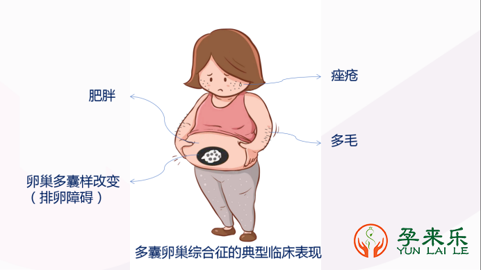 什么是多囊？女性多囊症状有哪些？