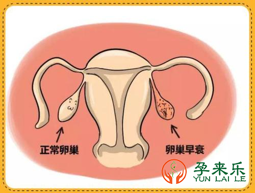什么是卵巢早衰？卵巢早衰可以供L试管吗？