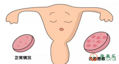 多囊卵巢的女性做试管必须注意些什么?